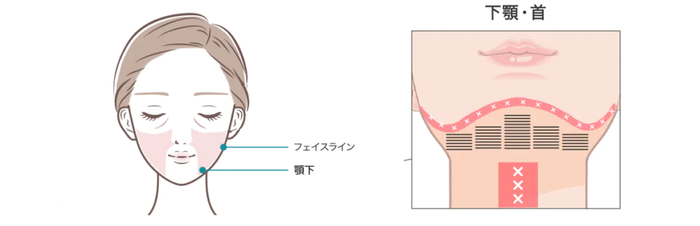 リフトアップハイフ